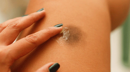 Por que ficamos com hematomas?